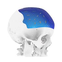 Custom-made cranial implant