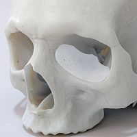Custom-made periorbital implant TnR seriesabsorbable