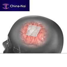 Bovine calcaneal tendon dural substitute DuraMatrix