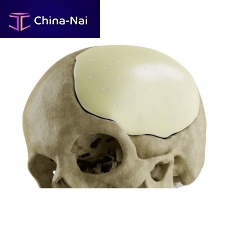 Custom-made cranial implant CROWN