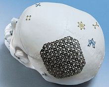 Non-absorbable cranial fixation system OPTIMUS