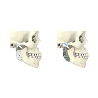Custom-made mandibular implant TMJnon-absorbable